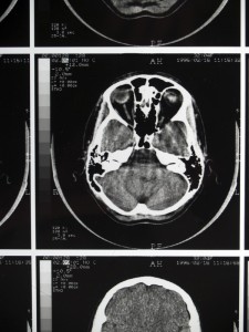 mri_scan_results