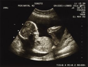 ultrasound_pregnancy